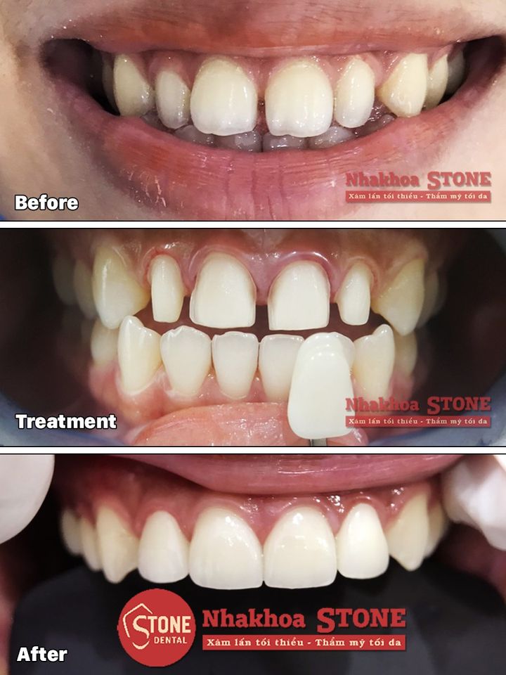 Điều trị răng thưa hiệu quả tại nha khoa Stone
